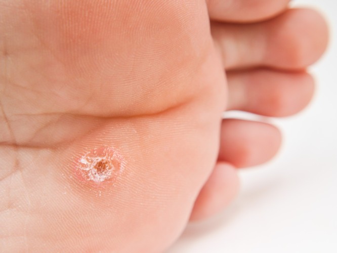 How To Get Rid of Plantar Warts