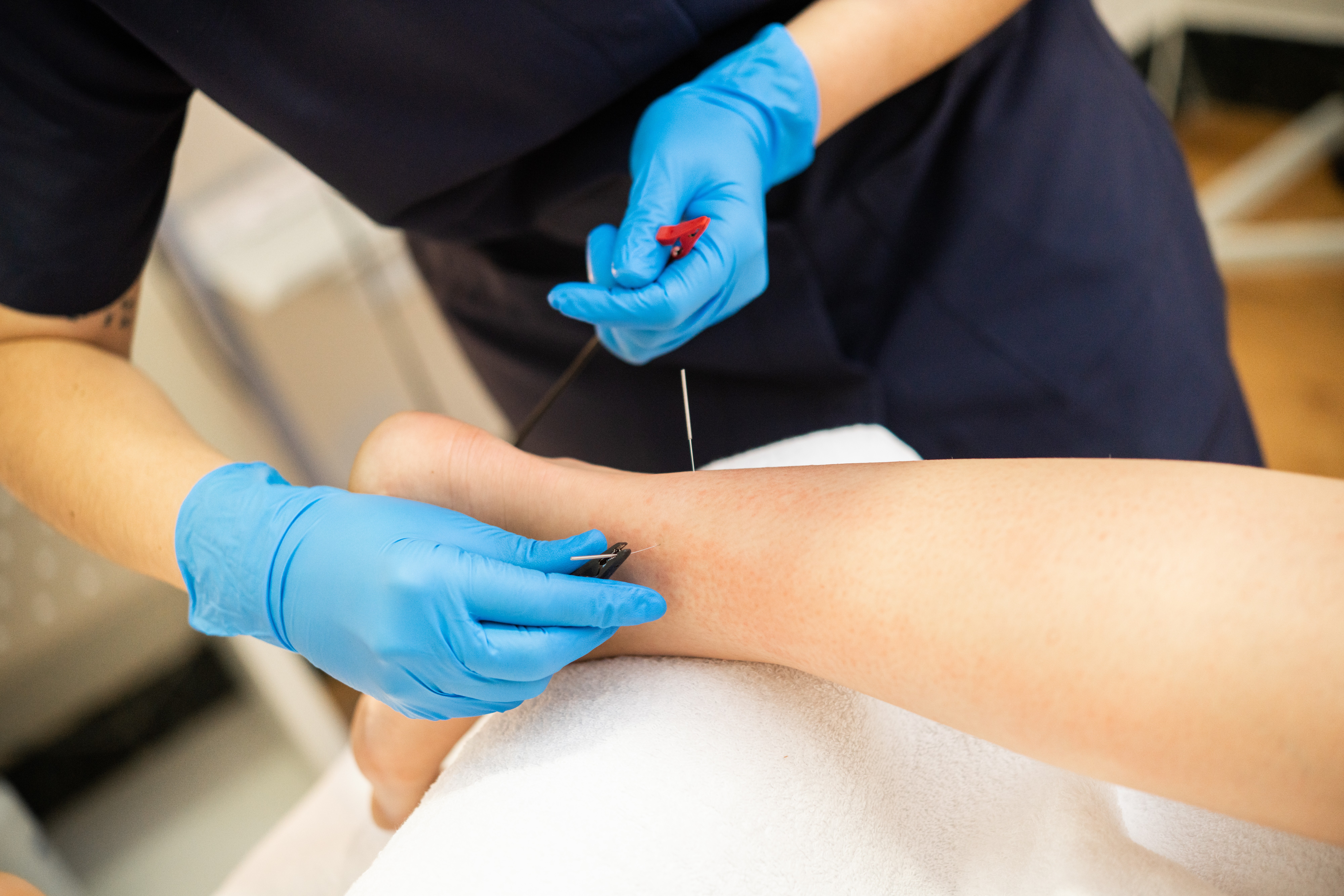 Acupuncture and Podiatry: A Modern Approach to Foot & Ankle Care
