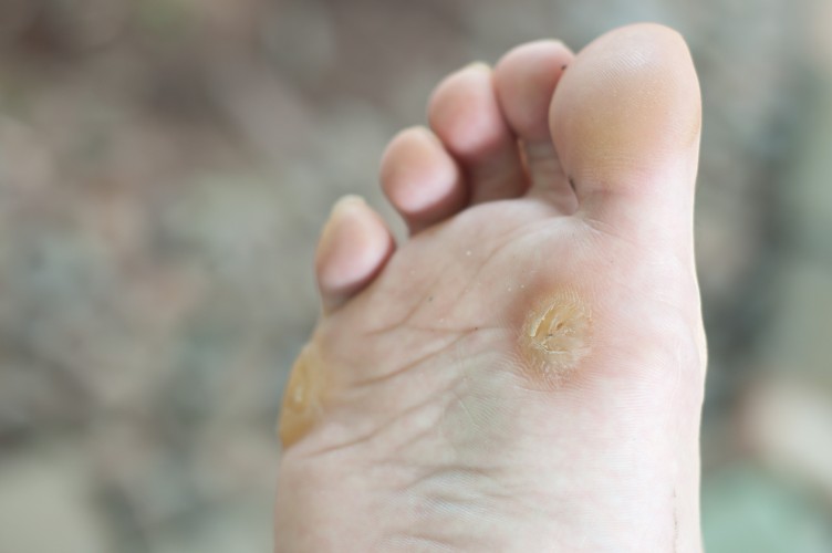 Get Rid Of Painful Corns and Callus instantly!