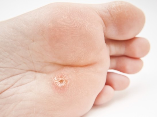 Person with callus located under foot, close to toes towards white