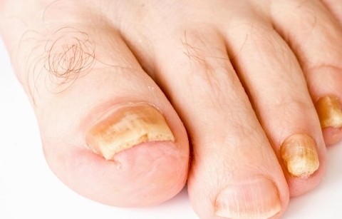 yellowed-toenails