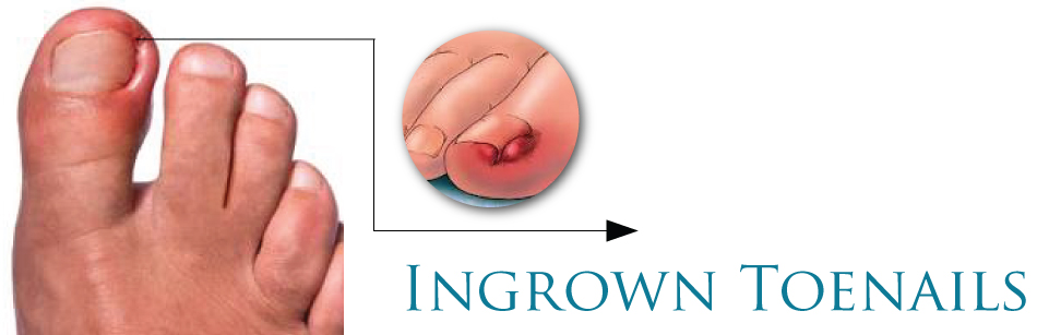 Struggling with ingrown toenails? - Perform Podiatry