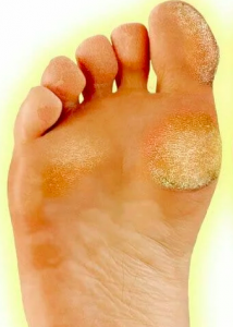 Chemical Foot Peel Removes Crusty Dead Skin and Callus Buildup