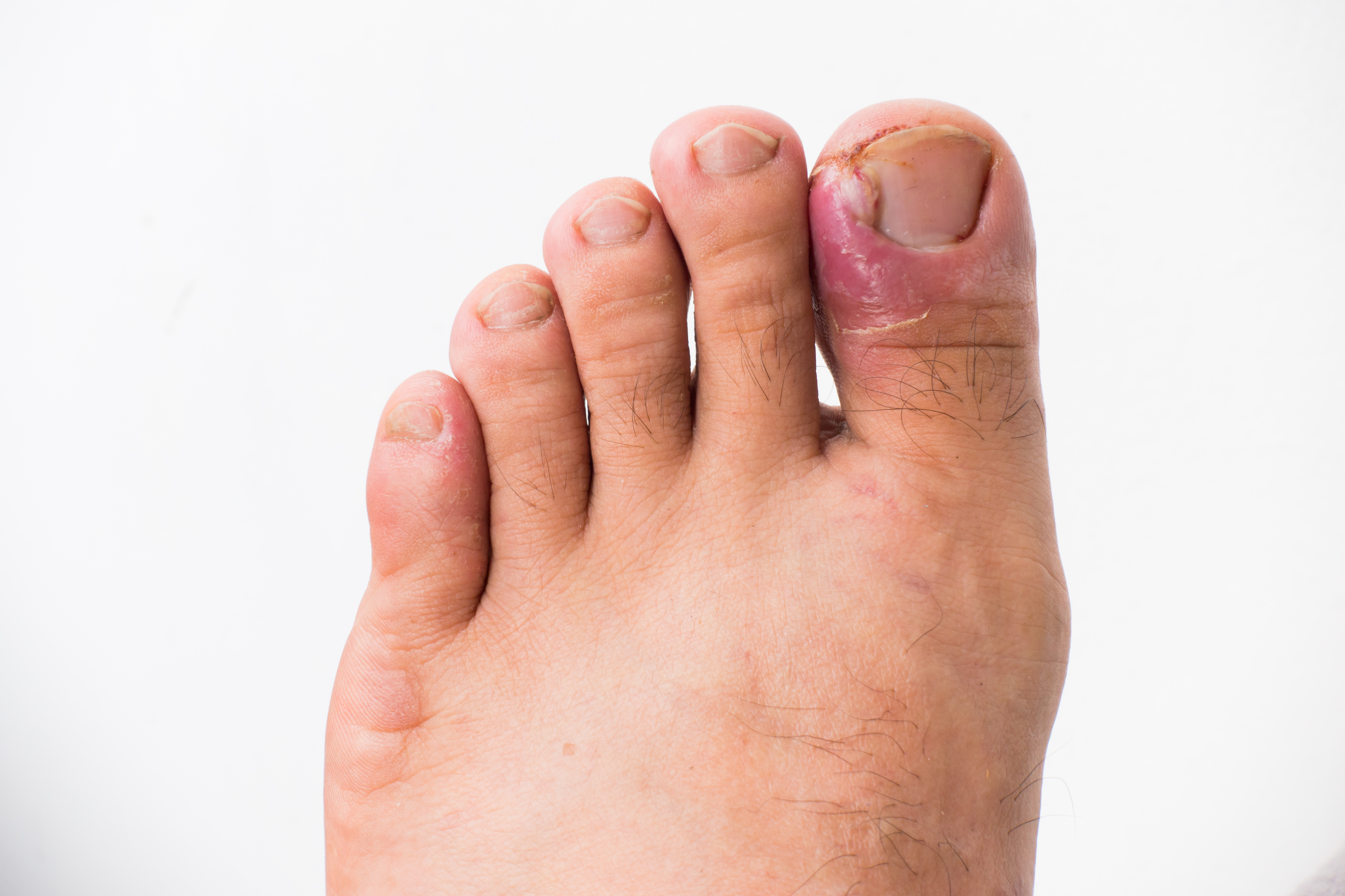 Is Your Ingrown Toenail Oozing Clear or Yellow Pus? It's Probably Infected  - Perform Podiatry