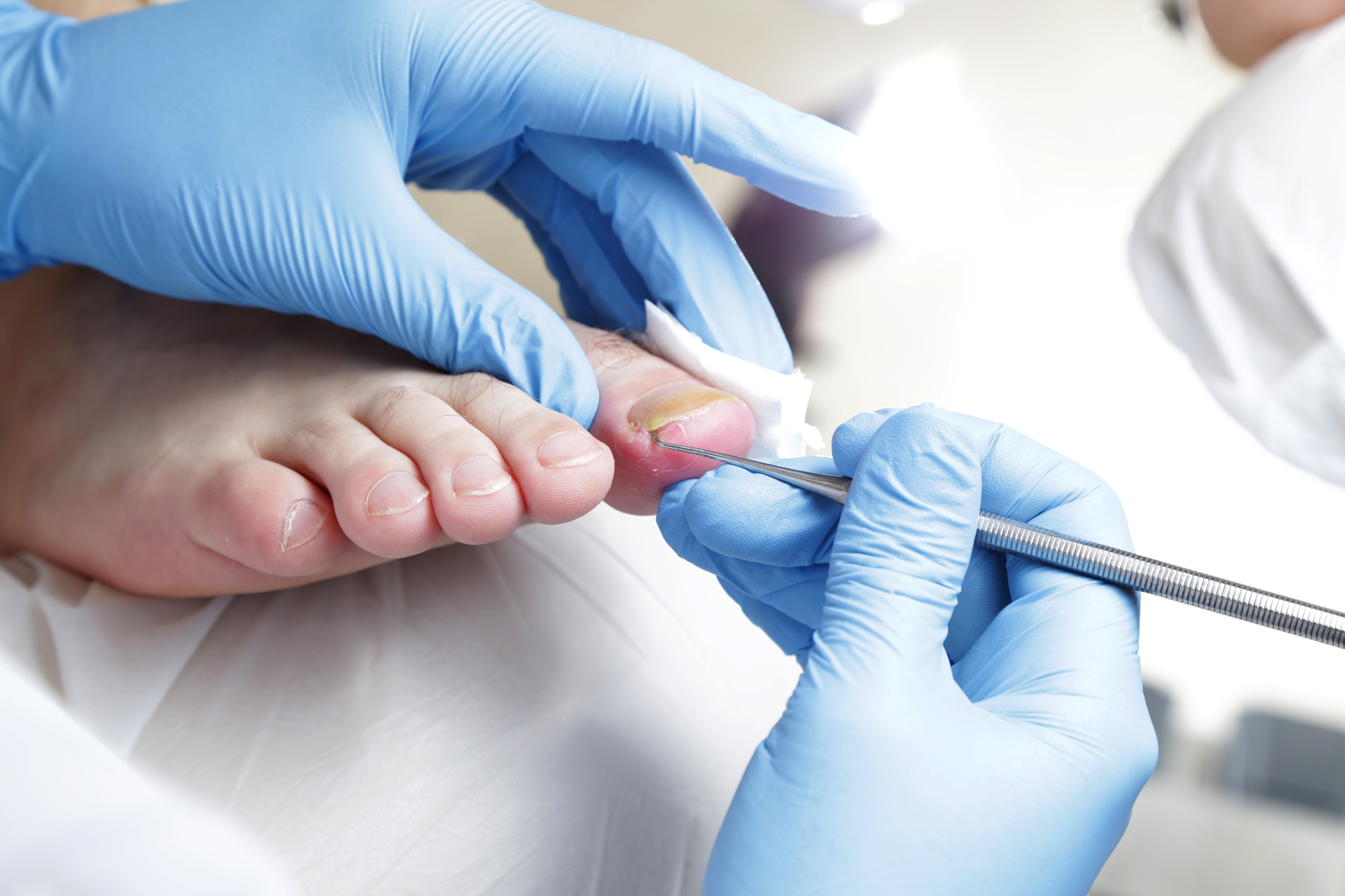 1 - Best Ingrown Toenail Surgery Cambridge | An Ingrown Toenail Is One That  Pierces The Flesh Of The Toe. It Can Feel As If You Have A Splinter, Be  Extremely Painful