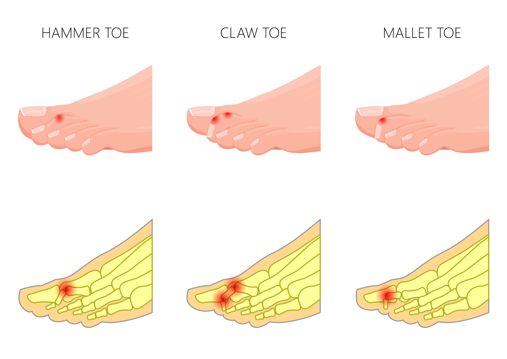 Fixing Curly Toes Hammertoes Claw Toes And Mallet Toes Perform Podiatry